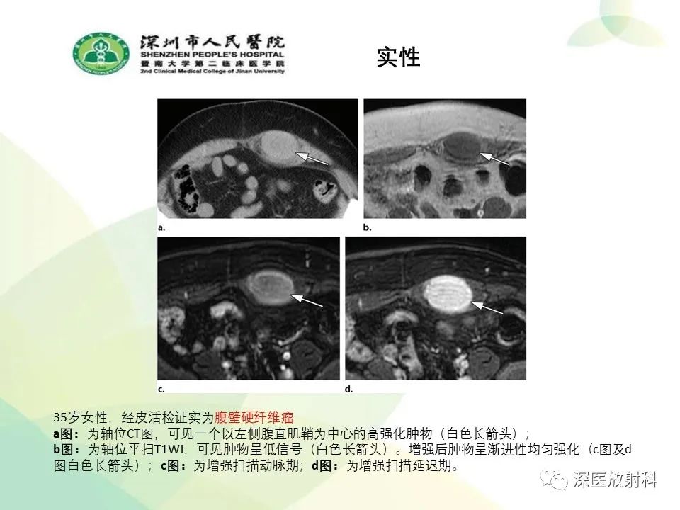 影像PPT - 【PPT】腹壁病变诊断思路-29