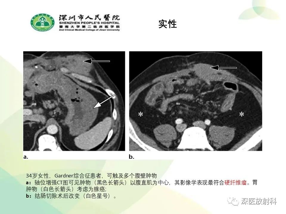 影像PPT - 【PPT】腹壁病变诊断思路-30
