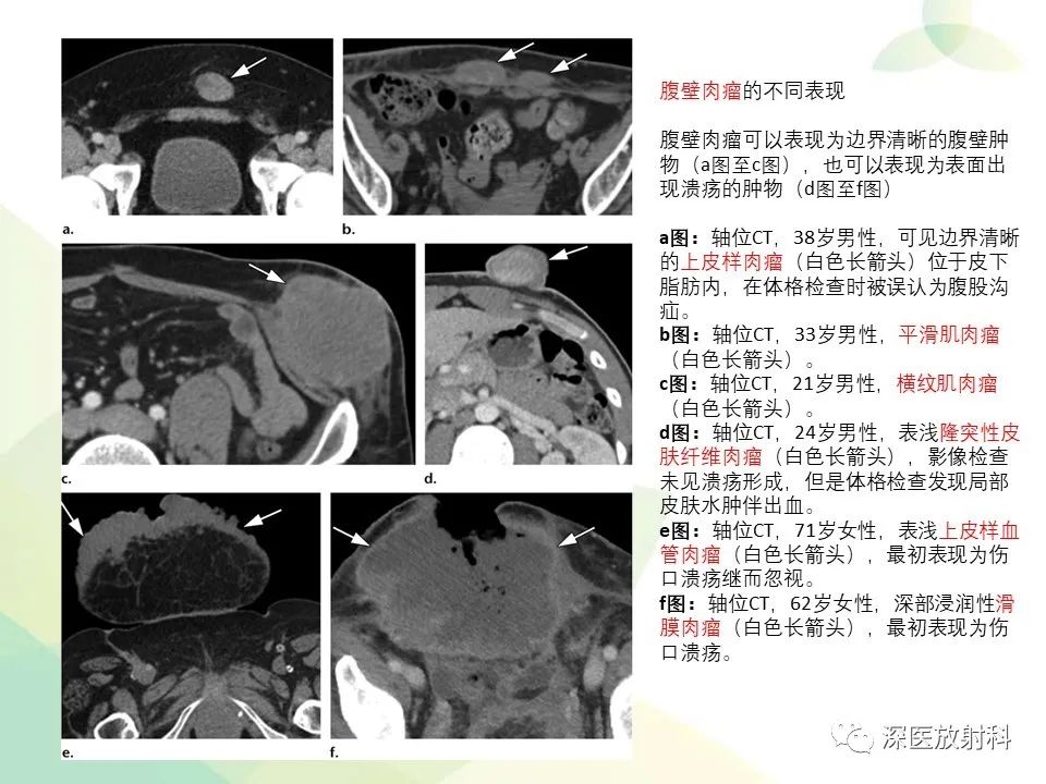 影像PPT - 【PPT】腹壁病变诊断思路-31
