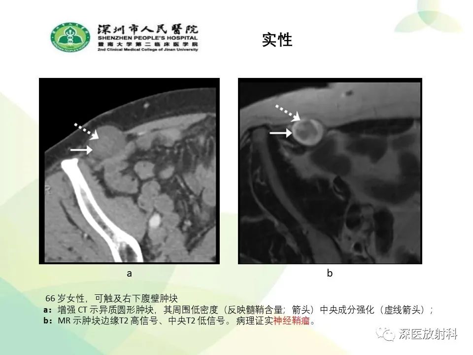 影像PPT - 【PPT】腹壁病变诊断思路-32