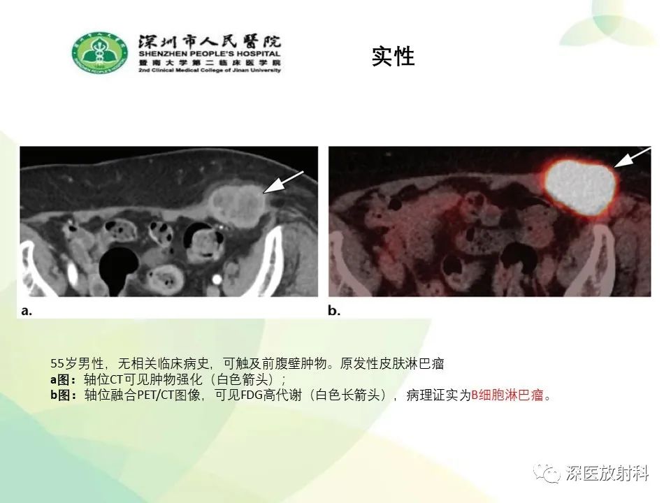 影像PPT - 【PPT】腹壁病变诊断思路-33