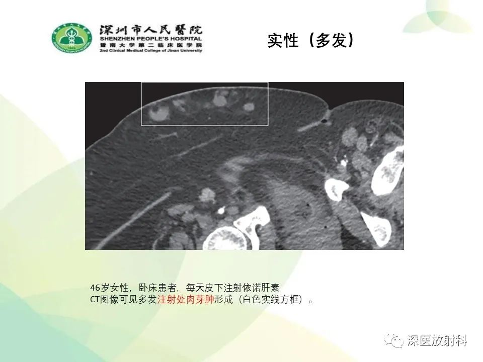 影像PPT - 【PPT】腹壁病变诊断思路-34