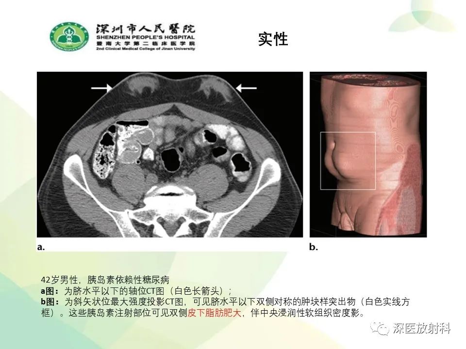 影像PPT - 【PPT】腹壁病变诊断思路-35