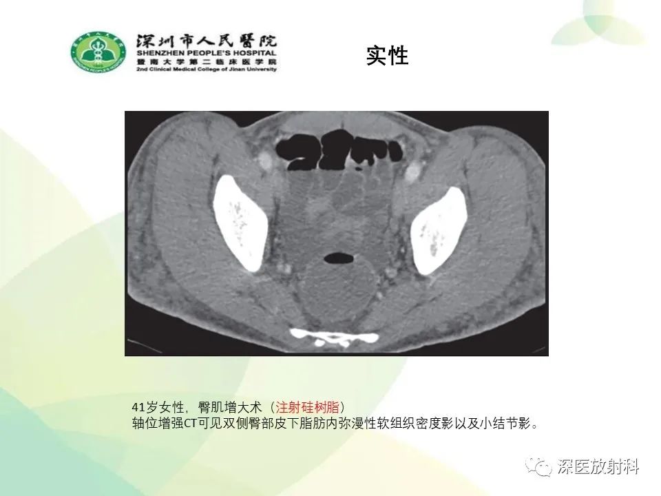 影像PPT - 【PPT】腹壁病变诊断思路-36