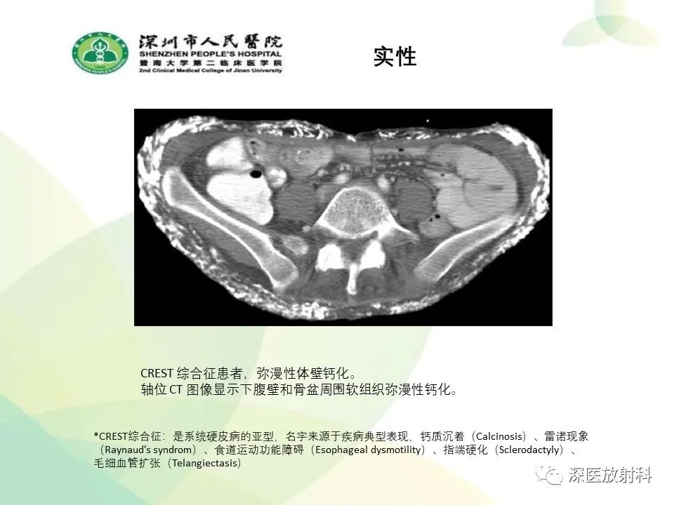 影像PPT - 【PPT】腹壁病变诊断思路-37