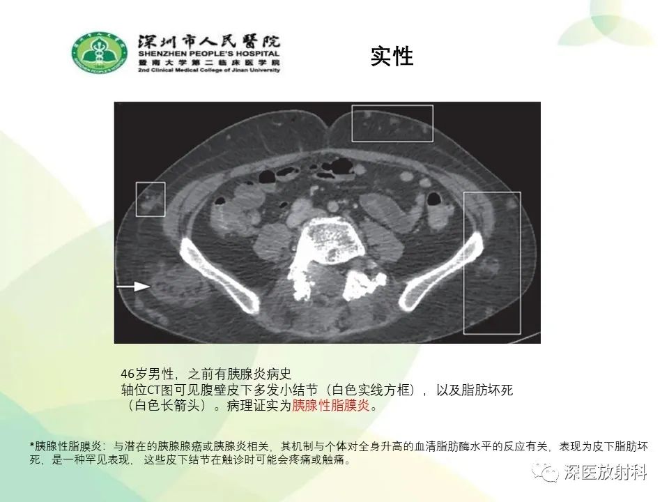 影像PPT - 【PPT】腹壁病变诊断思路-39