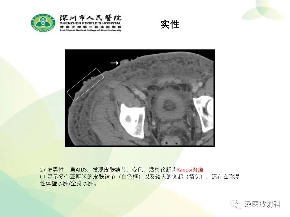 影像PPT - 【PPT】腹壁病变诊断思路-40