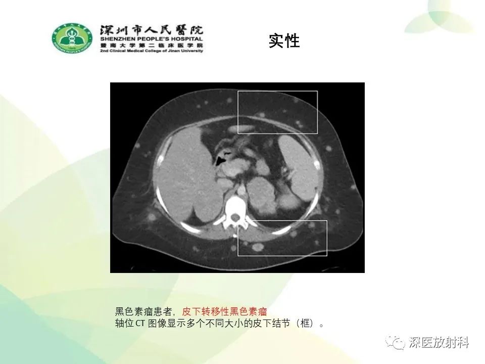 影像PPT - 【PPT】腹壁病变诊断思路-41