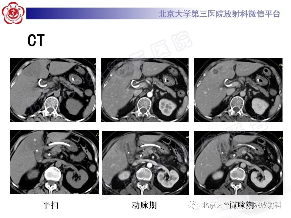 影像PPT - 【PPT】黄色肉芽肿性胆囊炎-3
