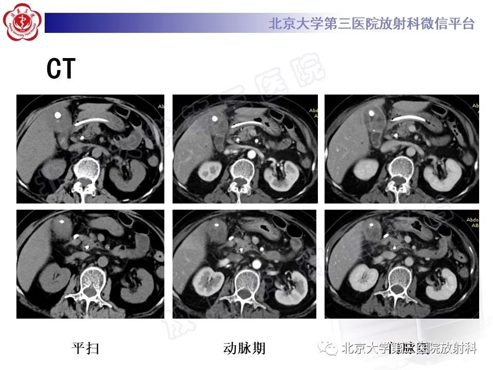影像PPT - 【PPT】黄色肉芽肿性胆囊炎-4