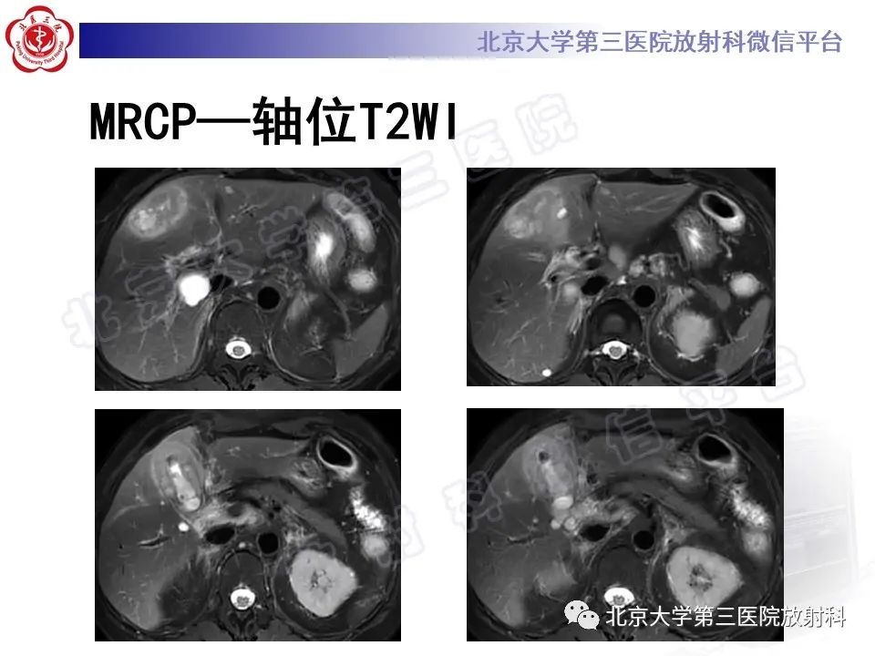 影像PPT - 【PPT】黄色肉芽肿性胆囊炎-6