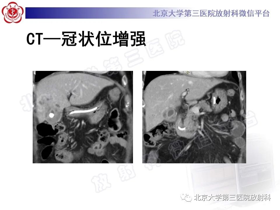 影像PPT - 【PPT】黄色肉芽肿性胆囊炎-5