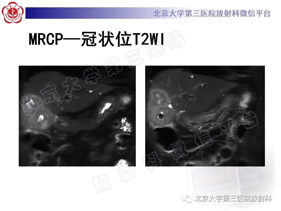 影像PPT - 【PPT】黄色肉芽肿性胆囊炎-7