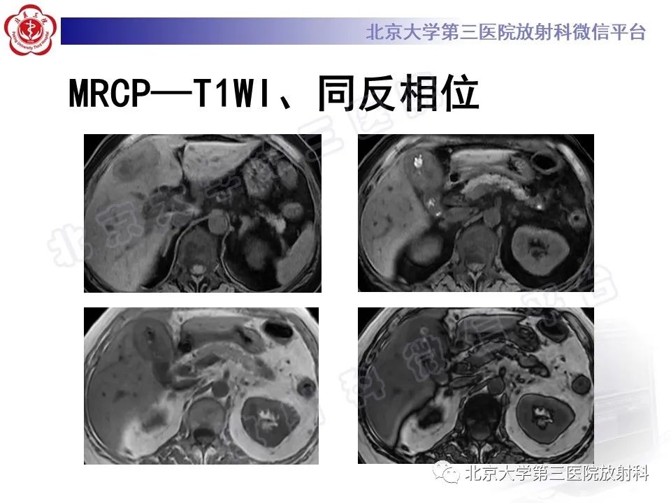 影像PPT - 【PPT】黄色肉芽肿性胆囊炎-8