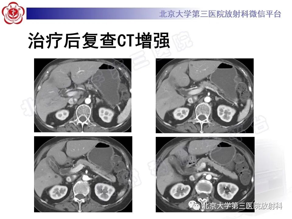 影像PPT - 【PPT】黄色肉芽肿性胆囊炎-11