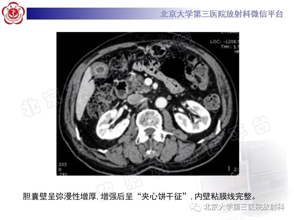 影像PPT - 【PPT】黄色肉芽肿性胆囊炎-20