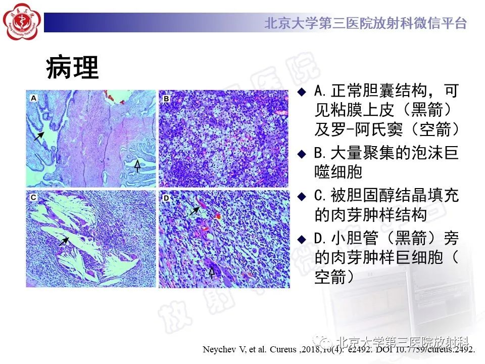 影像PPT - 【PPT】黄色肉芽肿性胆囊炎-16