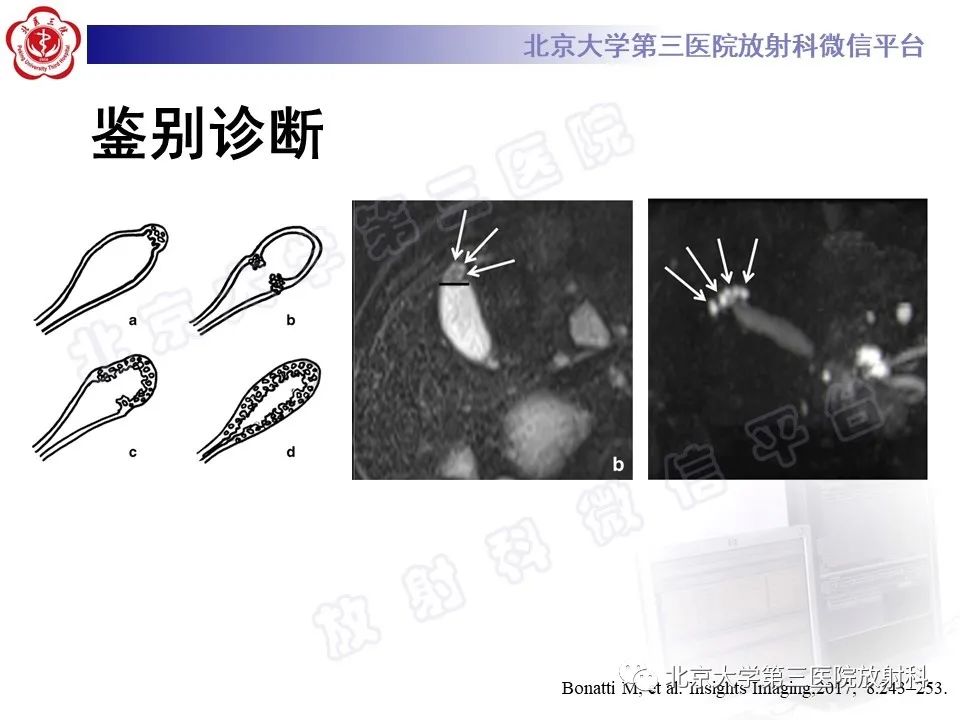 影像PPT - 【PPT】黄色肉芽肿性胆囊炎-26