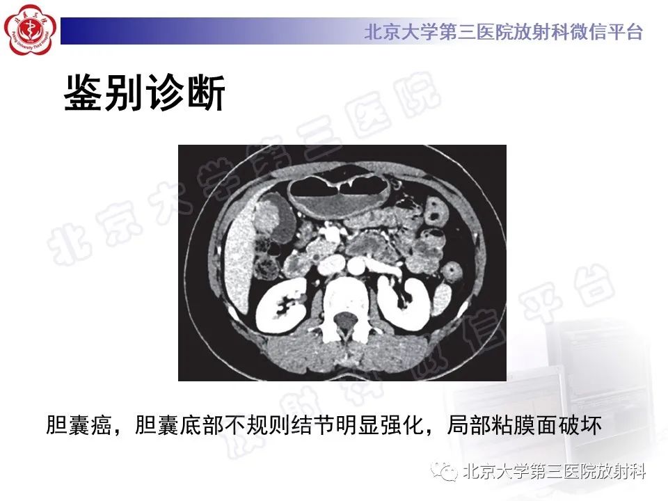 影像PPT - 【PPT】黄色肉芽肿性胆囊炎-24