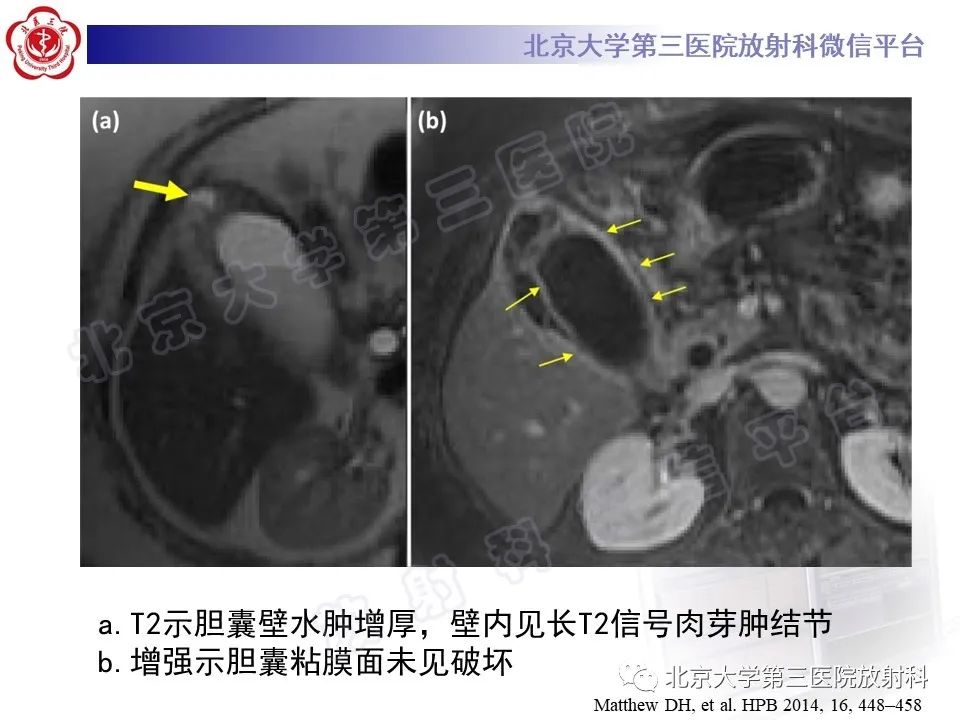 影像PPT - 【PPT】黄色肉芽肿性胆囊炎-22