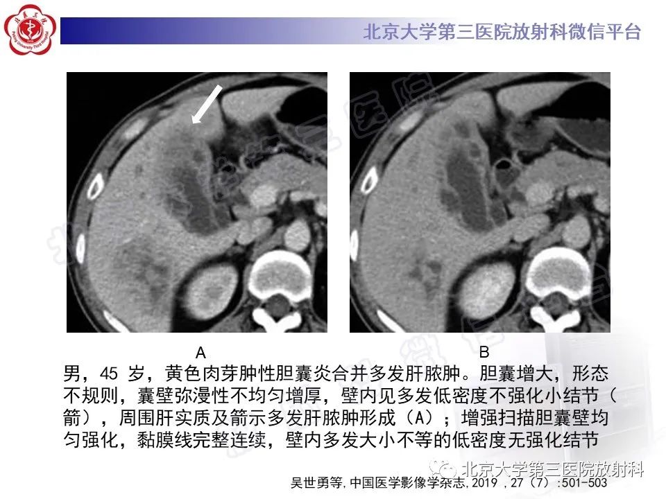 影像PPT - 【PPT】黄色肉芽肿性胆囊炎-21