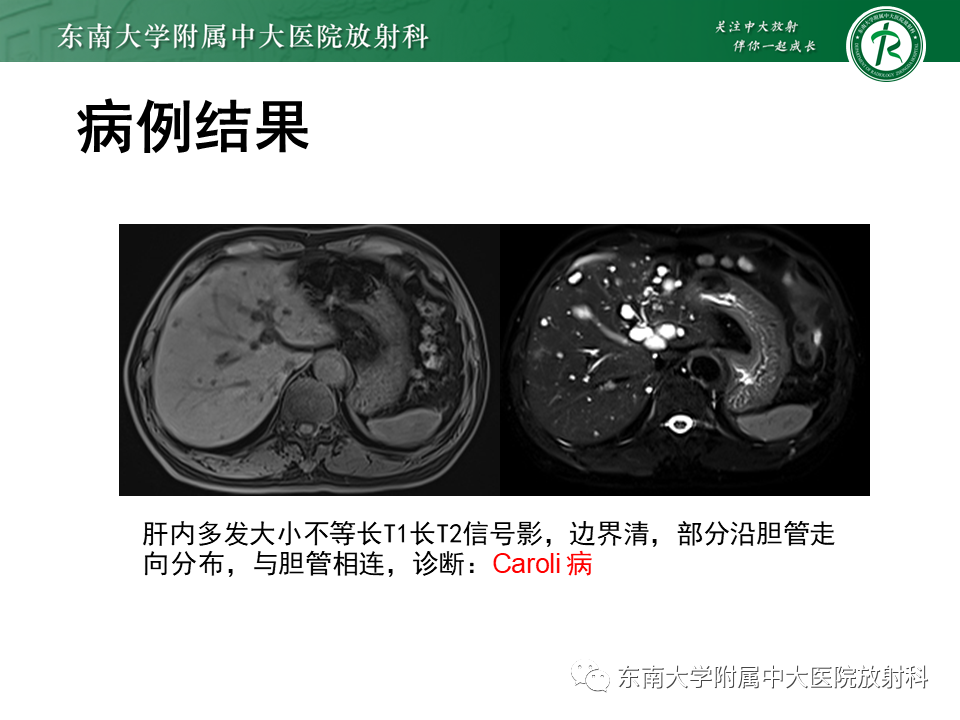 影像PPT - 【PPT】常见肝脏囊性病变的影像表现-2