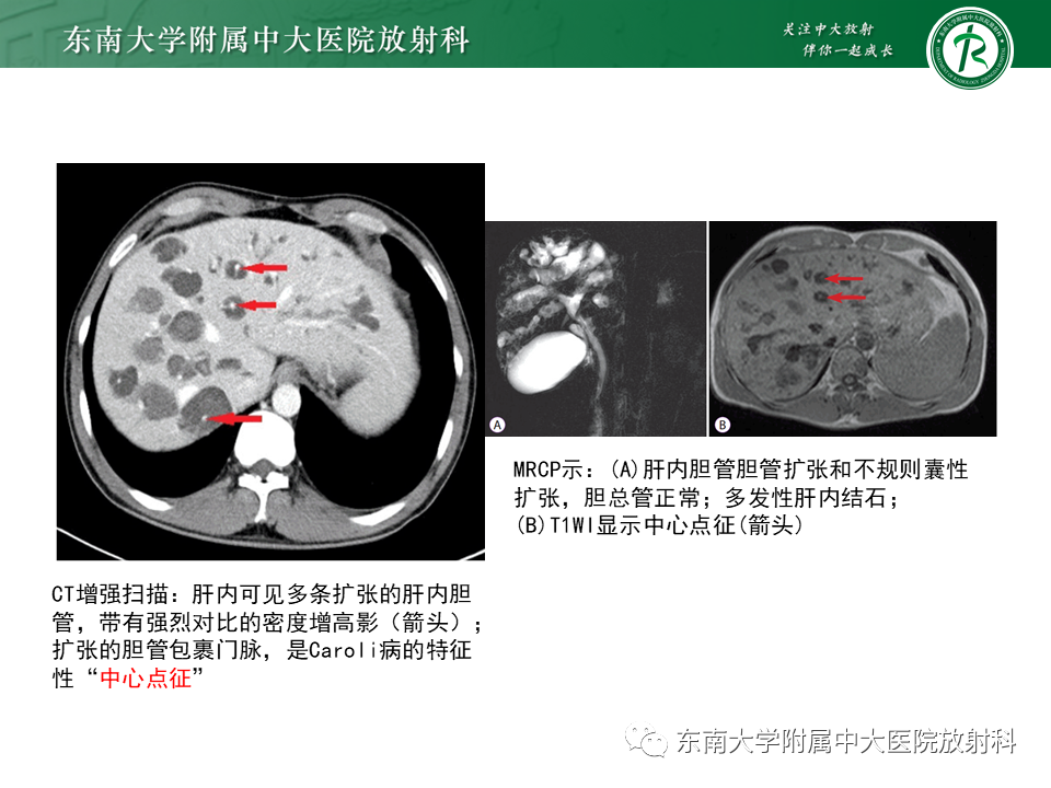 影像PPT - 【PPT】常见肝脏囊性病变的影像表现-12