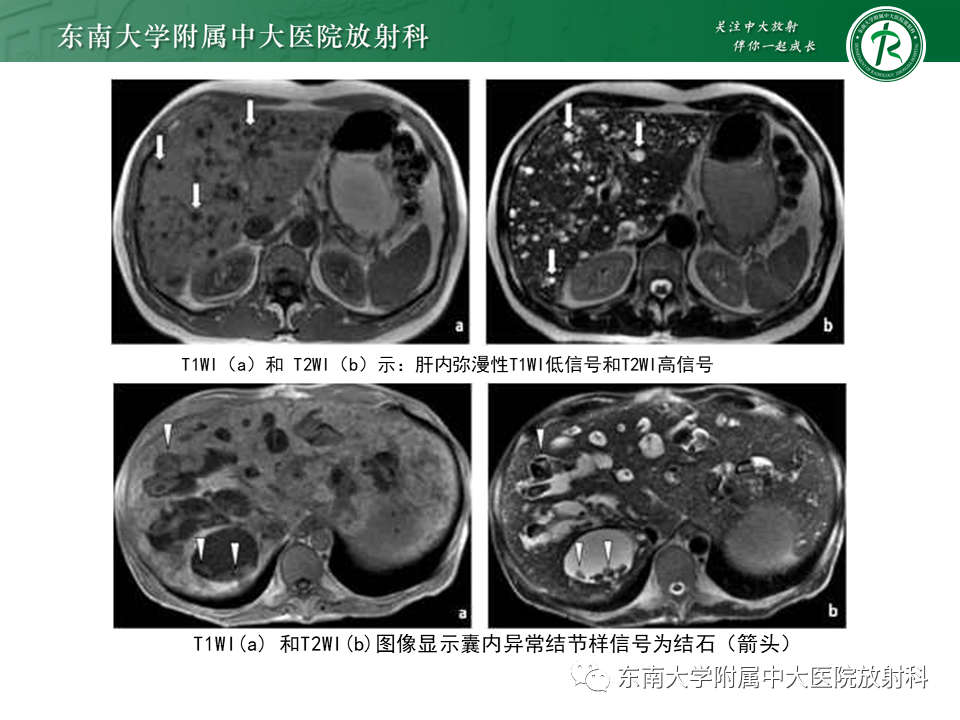 影像PPT - 【PPT】常见肝脏囊性病变的影像表现-13