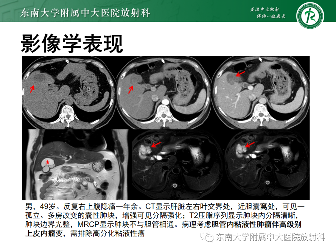 影像PPT - 【PPT】常见肝脏囊性病变的影像表现-17
