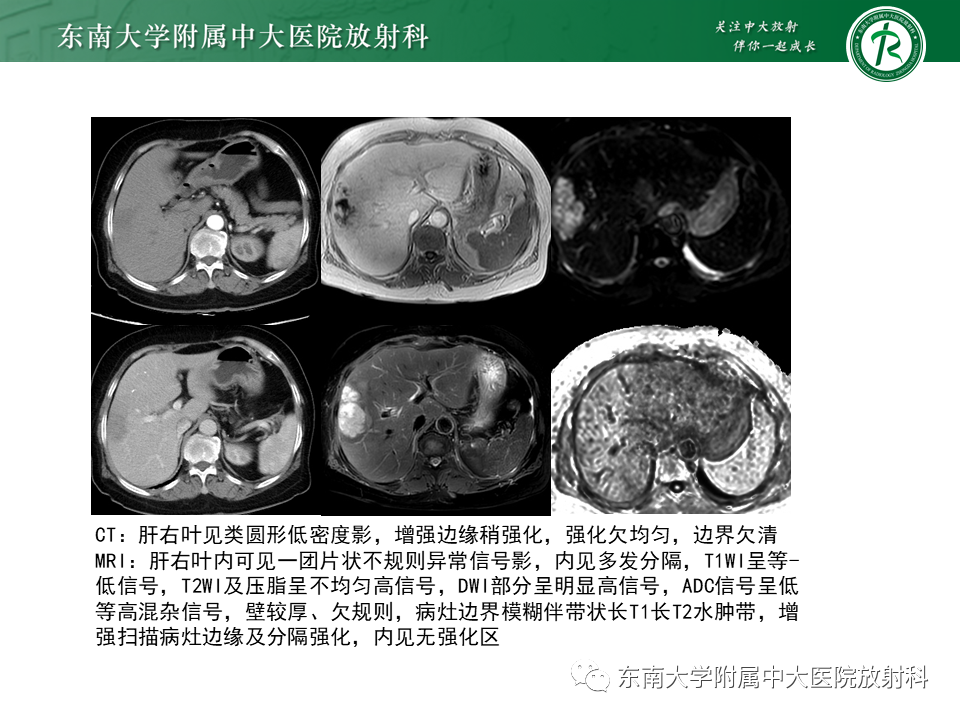 影像PPT - 【PPT】常见肝脏囊性病变的影像表现-20