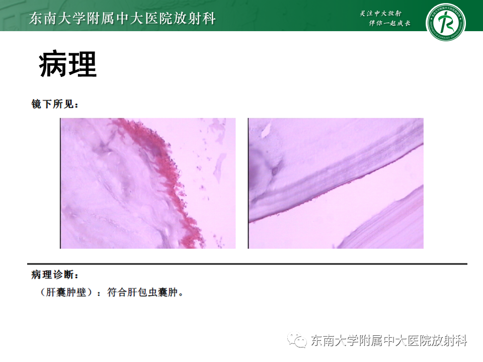 影像PPT - 【PPT】常见肝脏囊性病变的影像表现-24