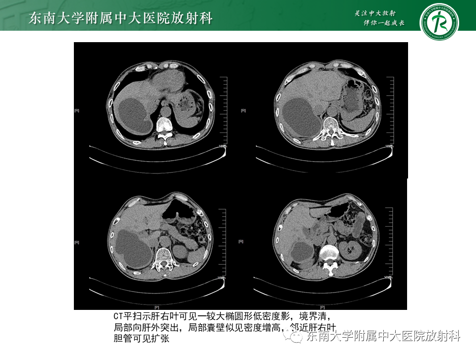 影像PPT - 【PPT】常见肝脏囊性病变的影像表现-23