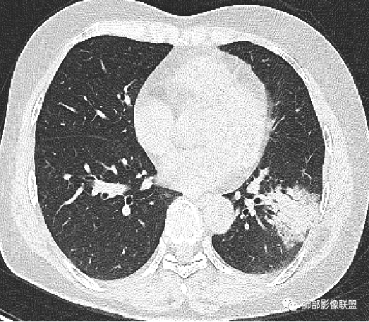影像PPT - 鹦鹉热衣原体肺炎影像及临床研究-5 影像PPT - 鹦鹉热衣原体肺炎影像及临床研究-5