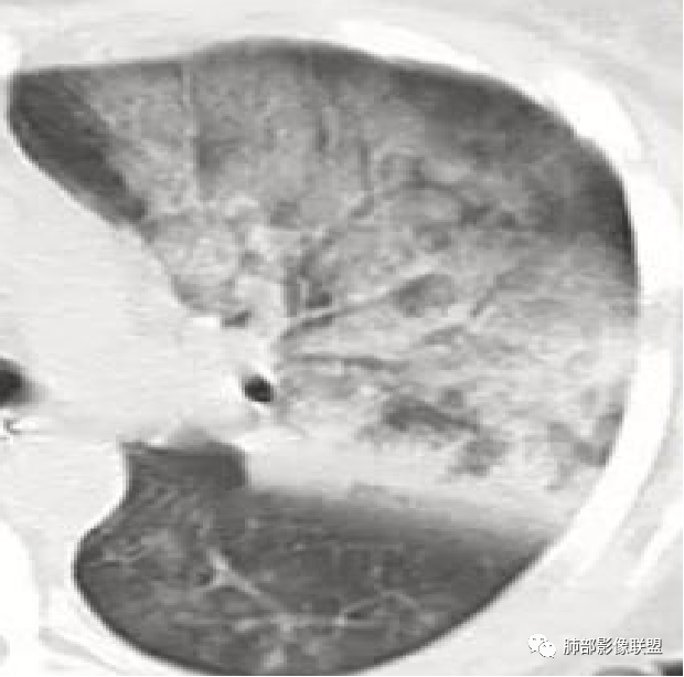 影像PPT - 鹦鹉热衣原体肺炎影像及临床研究-10 影像PPT - 鹦鹉热衣原体肺炎影像及临床研究-10