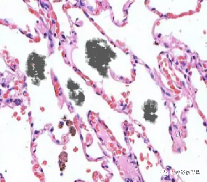 影像PPT - 鹦鹉热衣原体肺炎影像及临床研究-11 影像PPT - 鹦鹉热衣原体肺炎影像及临床研究-11