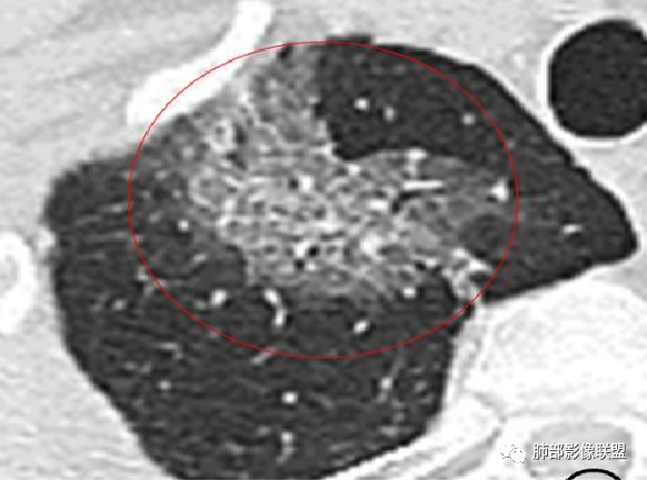 影像PPT - 鹦鹉热衣原体肺炎影像及临床研究-18 影像PPT - 鹦鹉热衣原体肺炎影像及临床研究-18