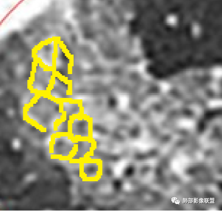 影像PPT - 鹦鹉热衣原体肺炎影像及临床研究-20 影像PPT - 鹦鹉热衣原体肺炎影像及临床研究-20