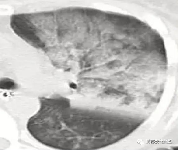 影像PPT - 鹦鹉热衣原体肺炎影像及临床研究-22 影像PPT - 鹦鹉热衣原体肺炎影像及临床研究-22