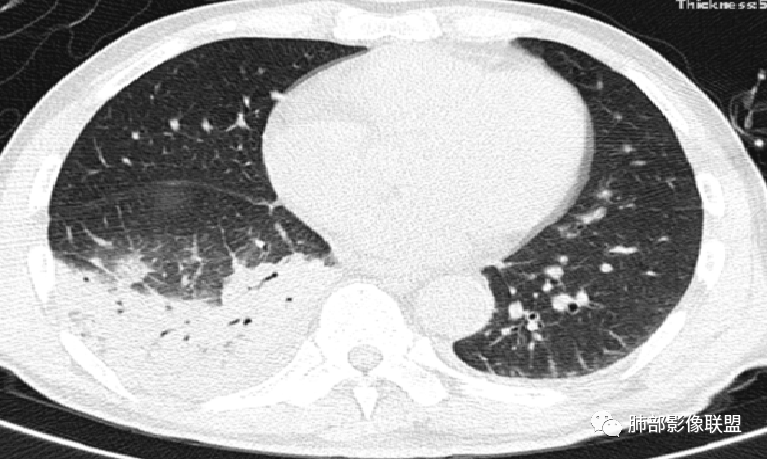 影像PPT - 鹦鹉热衣原体肺炎影像及临床研究-31 影像PPT - 鹦鹉热衣原体肺炎影像及临床研究-31
