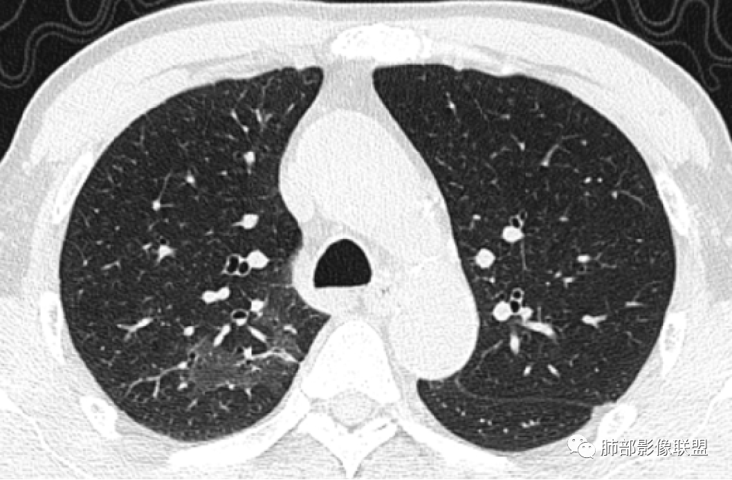 影像PPT - 鹦鹉热衣原体肺炎影像及临床研究-32 影像PPT - 鹦鹉热衣原体肺炎影像及临床研究-32