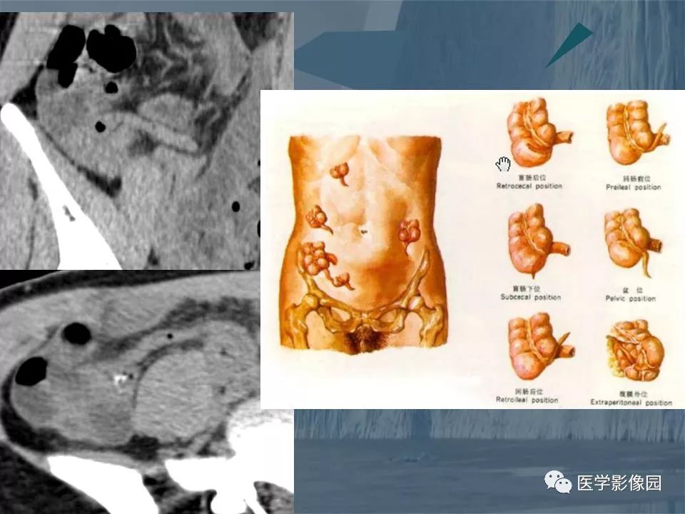 影像PPT - 【PPT】阑尾炎的CT诊断-10