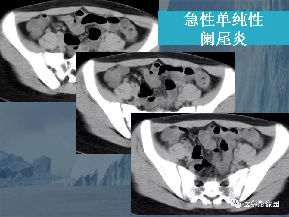影像PPT - 【PPT】阑尾炎的CT诊断-21