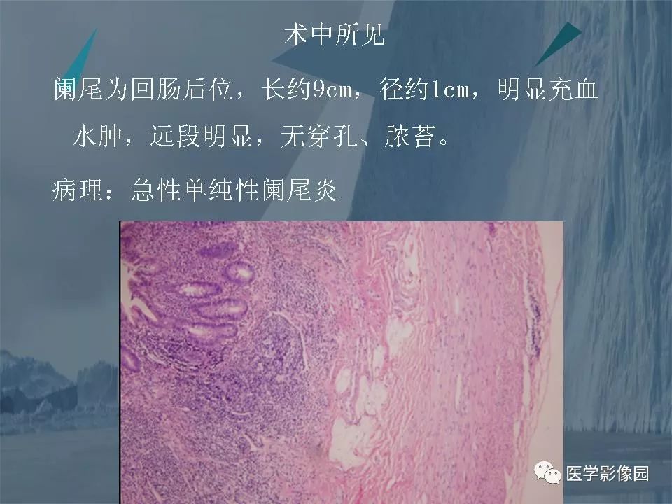 影像PPT - 【PPT】阑尾炎的CT诊断-22
