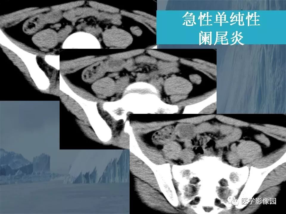 影像PPT - 【PPT】阑尾炎的CT诊断-24