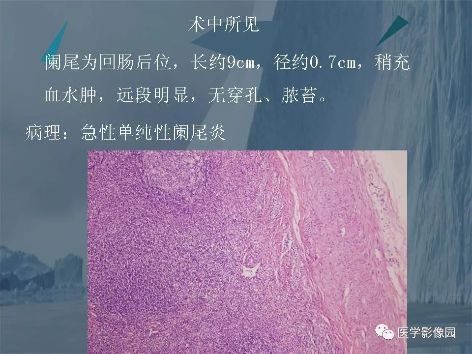 影像PPT - 【PPT】阑尾炎的CT诊断-25
