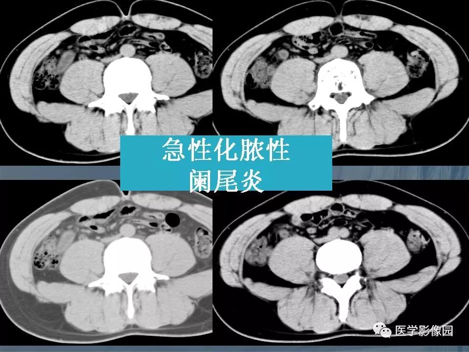 影像PPT - 【PPT】阑尾炎的CT诊断-27