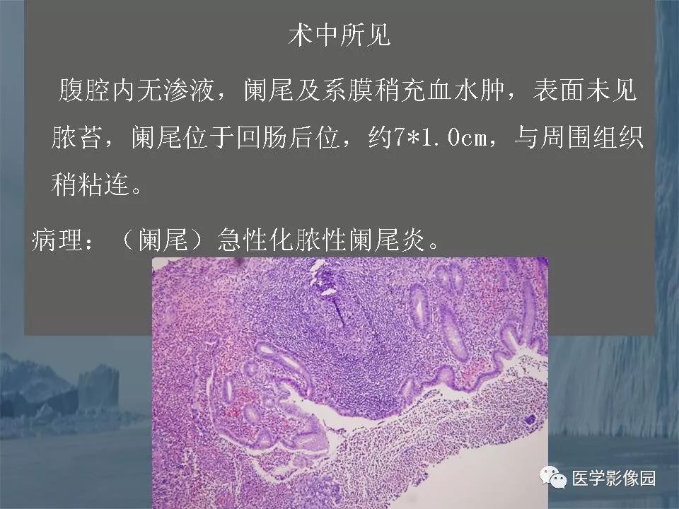 影像PPT - 【PPT】阑尾炎的CT诊断-28
