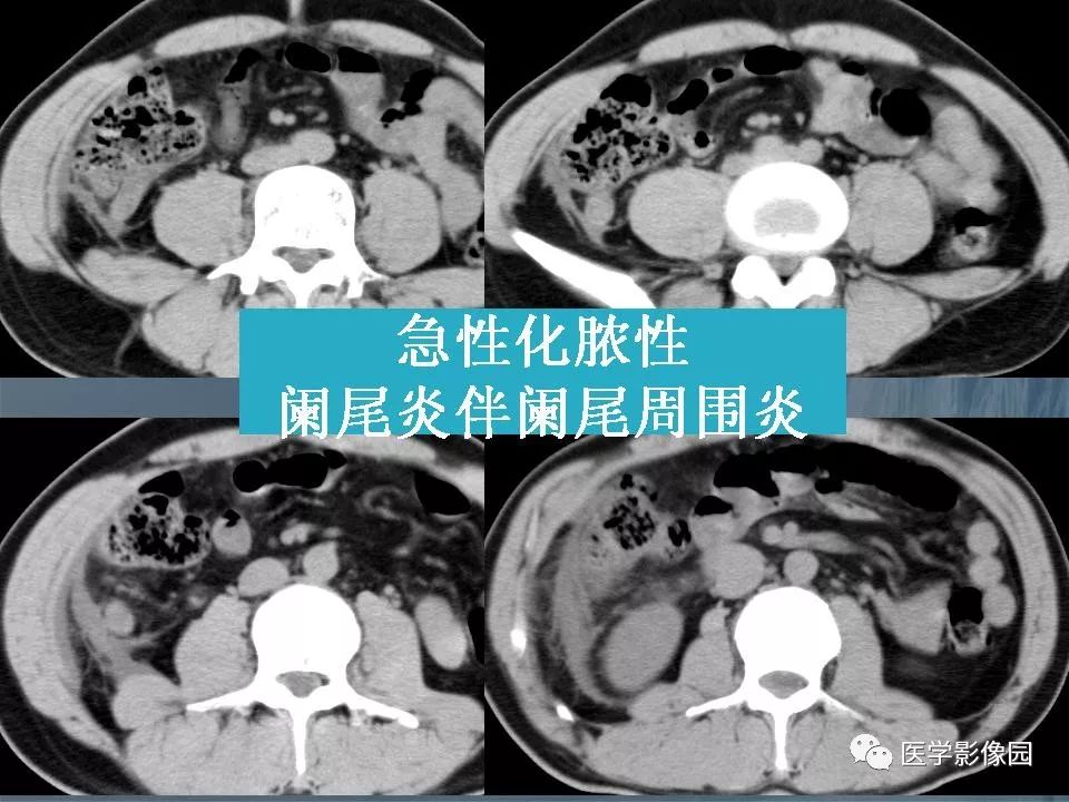 影像PPT - 【PPT】阑尾炎的CT诊断-30