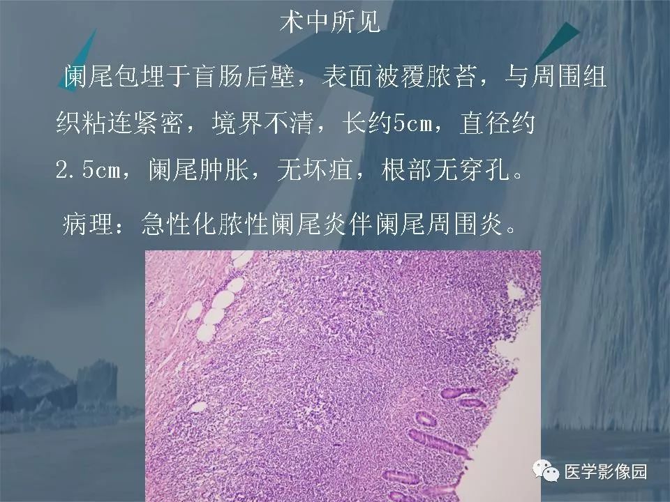 影像PPT - 【PPT】阑尾炎的CT诊断-31