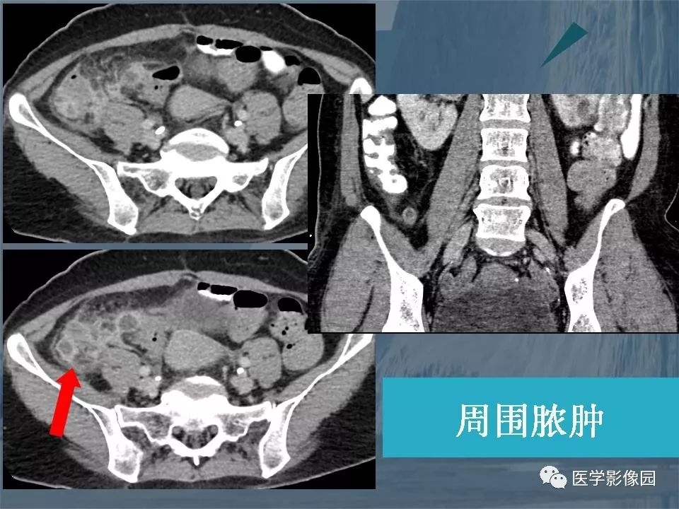 影像PPT - 【PPT】阑尾炎的CT诊断-34